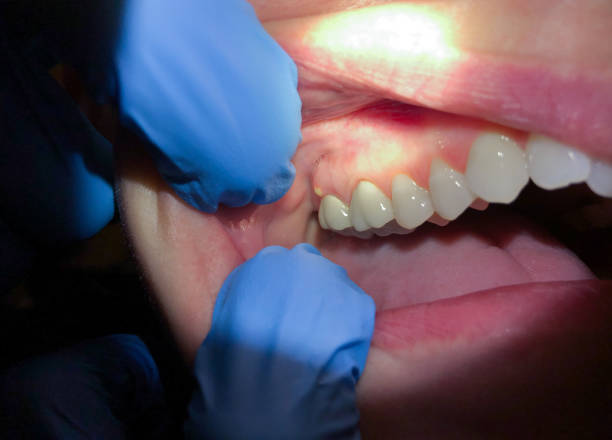 Best Broken or Cracked Tooth Emergency Dentist in Guntersville, AL