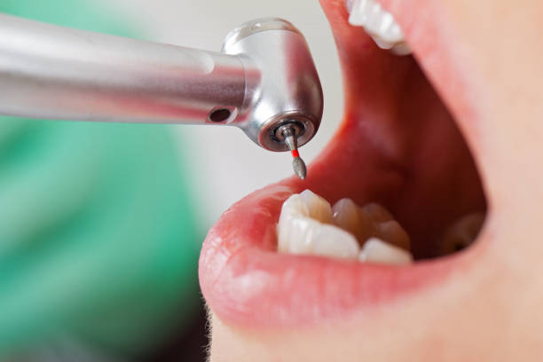 Best Emergency Dentist for Lost Fillings or Crowns in Guntersville, AL